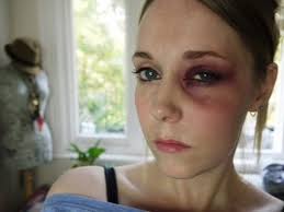 bruised black eye makeup tutorial by