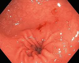 abnormal gastric mucosa