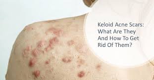 keloid acne scars what are they and