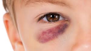 black eye what causes it and how to