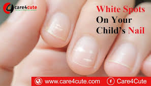 white spots on your child s nail