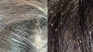 head lice or dandruff