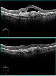 Age Related Macular Degeneration Eyewiki