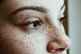 freckles explained how to check your