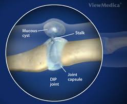 digital mucoid cysts the hand and