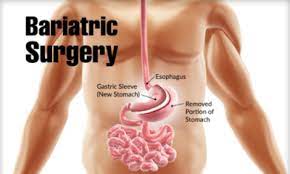 what is the procedure of bariatric surgery
