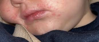 2 year old with red spots around mouth