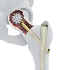 depuy synthes launches tfna
