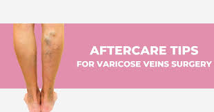 varicose veins surgery