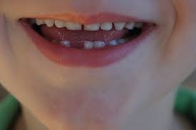 When can my kid get braces?