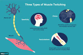muscle twitches ms and other possible