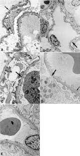 Thin Basement Membrane Nephropathy