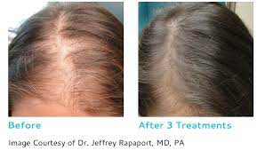 prp hair restoration in toronto dr beber