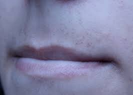 upper lip electrolysis scarring