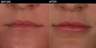thin lips lip injections macon