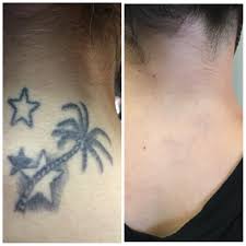 Preparing instructions for picosure laser tattoo removal. Cleveland Oh Ink On Ink Off 5 Factors That Determine Laser Tattoo Removal Success