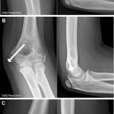 Primary constraints=ulnohumeral articulation(coronoid), medial collateral ligament(mcl), lateral collateral. Pdf Does Operative Fixation Affect Outcomes Of Displaced Medial Epicondyle Fractures