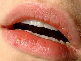 cold sores causes and symptoms