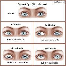 what is strabismus squint eye