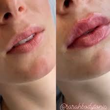 best lip injections in austin tx