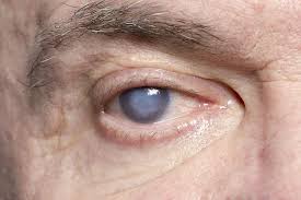 cataracts motiyabind symptoms