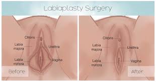 Unfortunately, in most cases insurance will not cover or approve labiaplasty surgery. All You Need To Know About A Designer Vagina And Labiaplasty Vagifirm