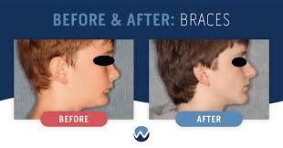 before after braces see the amazing