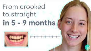Crooked teeth have a variety of causes, from genetics, malnutrition & oral habits to dental disease. How To Straighten Crooked Teeth Easily And Affordably Without Metal Braces Youtube