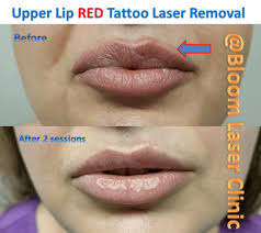 laser tattoo removal bloom laser clinic