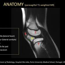 Knee muscle anatomy mri (page 1) knee anatomy mri driverlayer search engine knee anatomy mri knee coronal anatomy these pictures of this page are about:knee muscle. Focal Herniation Of Hoffa S Fat Pad Through A Retinaculum Defect Eurorad