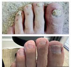 bay area fungal nail clinic