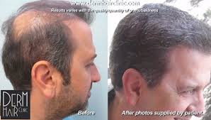 Prescreened and top ranked by patients for the very best results. Hair Transplant Repair Using Ugraft Dermhair Clinic Los Angeles