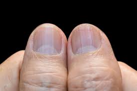 rheumatoid arthritis nail changes