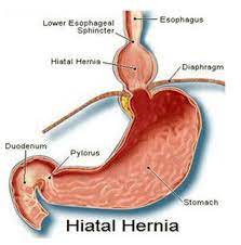 hiatal hernia pictures symptoms