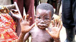 According to colette flight writing for the bbc, it killed an estimated 300 that's why it's called monkeypox and not ferretpox. Monkeypox And Memories Of Ebola Virus Disease The Guardian Nigeria News Nigeria And World News Features The Guardian Nigeria News Nigeria And World News