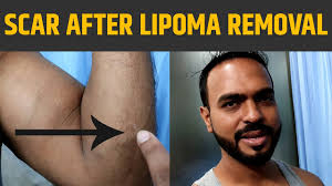 lipoma removal result after 8 months