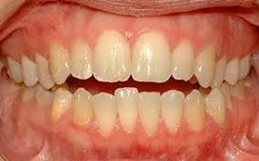 Finally, visit our website or give us a call today to take advantage. Common Orthodontic Problems Cope Ortho Dr Jason B Cope Braces Clear Aligners And Invisalign In Dallas Tx