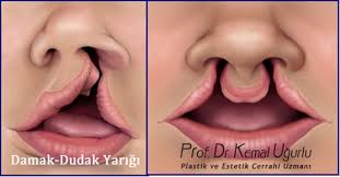 cleft lip and palate treatment prof
