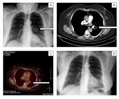 pulmonary lipoma in an atypical
