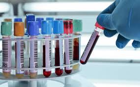 Các chỉ số cơ bản khi xét nghiệm sinh hóa máu