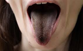 black tongue alcohol abuse causes