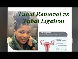 i had my s removed tubal removal