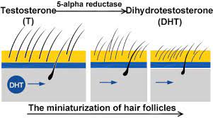 This means that although dht isn't fully responsible for hair loss in aga, it does play a key role. Hair Loss In Men