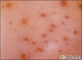 herpes simplex in depth reports st