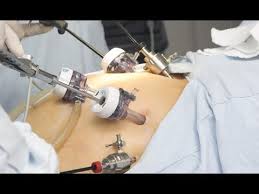laparoscopic gastric byp surgery