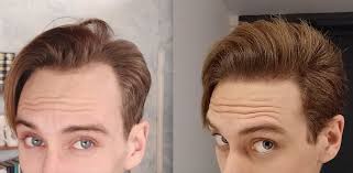 It will be removed in 24 hours. M26 9 Months After Hair Transplant Ama Tressless
