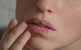 chapped lips symptoms causes and risk
