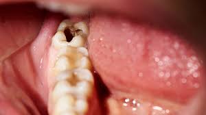 how dental visits help bad breath