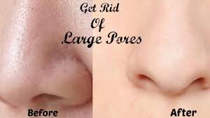 How to get rid of a pimple on the nose fast? How To Get Rid Of Large Pores In 7 Days Shrink Large Pores Get Smooth Fairer And Tighter Skin Youtube