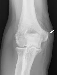 Posterolateral elbow dislocation, which may spontaneously. Plain Film Of The Elbow Showing A Soft Tissue Calcification Arrow Download Scientific Diagram